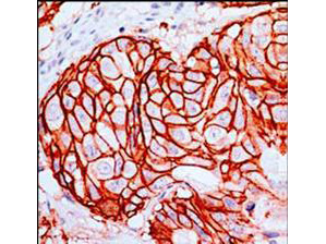 Anti-c-erbB2 Monoclonal Antibody (Rabbit) was used to detect c-erbB2 in human breast tumor tissue. Tissue was formalin-fixed and paraffin embedded. Staining requires boiling of sections in 10 mM citrate buffer pH 6.0 for 10 min followed by cooling at RT for 20 min. The primary antibody (cat. nr 900-C01-B37-C) was diluted 1:100 and reacted with tissue for 30 min at RT.