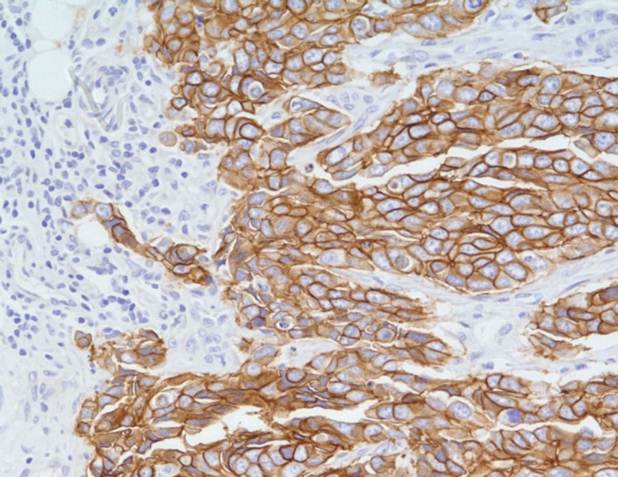 Anti-c-erbB-2/HER-2 antibody stains Human Breast Carcinoma (cat. nr 900-C01-B37).