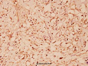 Anti HSP60 (281BS1179-50ul) in breast cancer tissues by IHC Bioworld Technology tebu-bio mitochondrial research