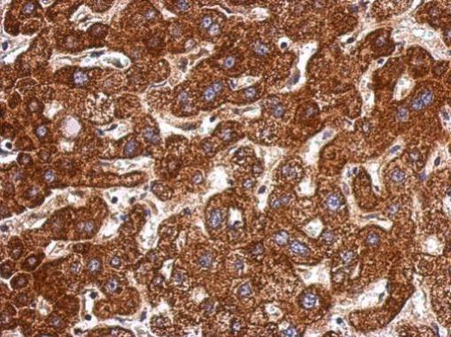 Immunohistochemical analysis of paraffin-embedded human hepatoma to detect Lanosterol Synthase with anti LSS (GTX105363)
