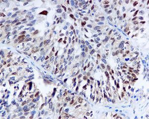 IHC-P analysis of human urothelial carcinoma tissue using anti Cdk4 antibody [EPR4513] (210GTX63389).
